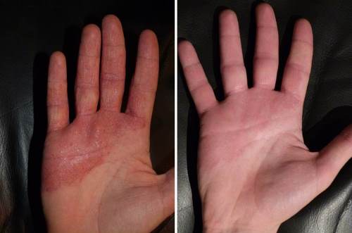 Autumn Skin Flare-Ups
