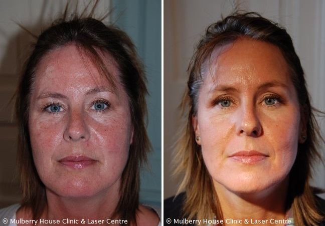 New Before and After Photos for Rosacea Treatment