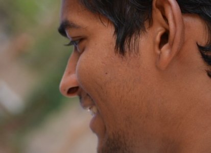 What can Non-Surgical Rhinoplasty Fix?
