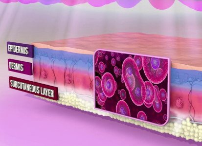 LED - Light-Based Skin Treatment