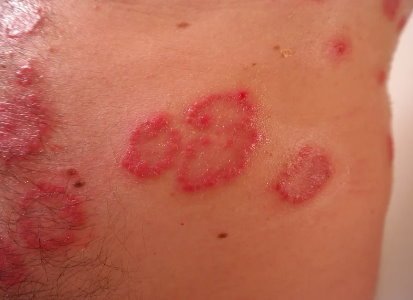 Psoriasis, the Sun and Hot Weather