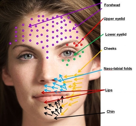 PRP Treatment Areas