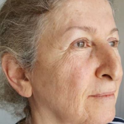 Tixel Thermal Fractional Facial Rejuvenation Results