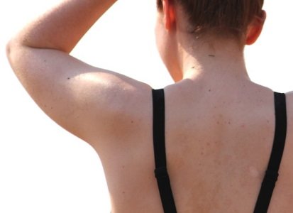 IPL Hair Removal Success Stories