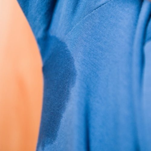 No Sweat... Hyperhidrosis Injections to the Rescue!