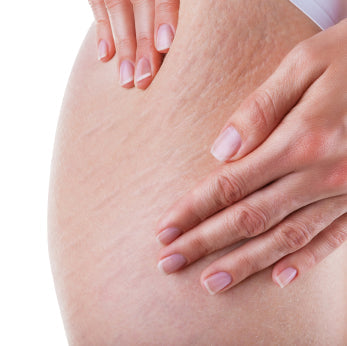New Stretch Mark Cream, As Seen on Mumsnet