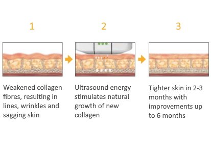 How do ultrasound treatments work?