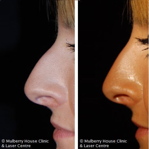 Non-Surgical Rhinoplasty Before and After Photos