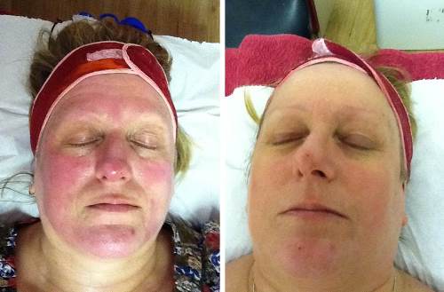 LED before and after rosacea