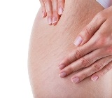 stretch mark treatment