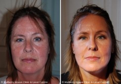 Understanding and Managing Rosacea