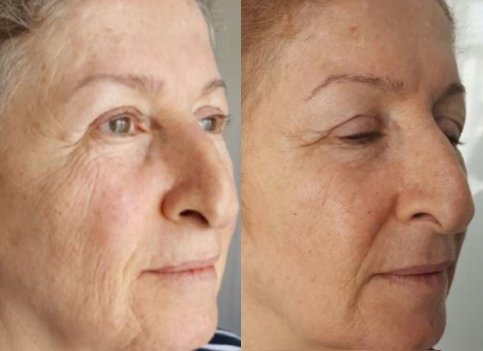 before and after tixel facial rejuvenation