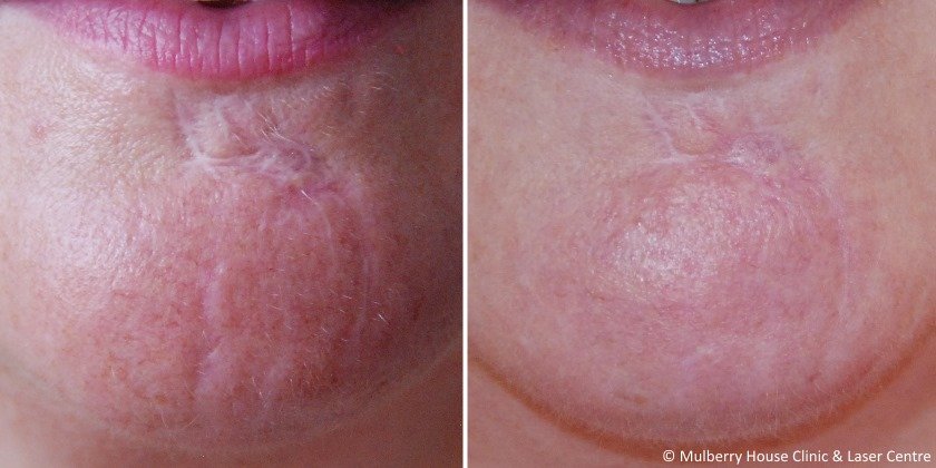 before and after scar treatment results