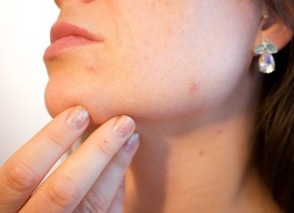 7 Signs That Acne is Healing 
