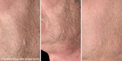 Anti-Ageing Home RNR Results Photos | Mulberry House Clinic