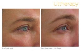 Ultherapy Brow Lift