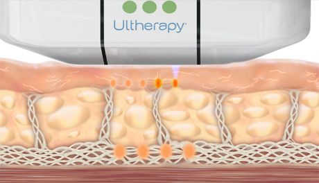 Ultherapy Collagen Stimulation