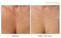 Ultherapy Decolletage Before and After