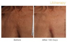 Ultherapy Decolletage Results