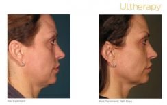 Ultherapy Full Face Lift Results