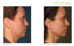Ultherapy Full Face Lift Results
