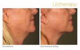 Ultherapy Lower Face Lift Before and After