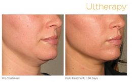 Ultherapy Lower Face Lift Results