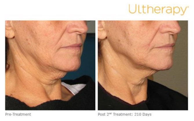 Ultherapy Before & After Photos