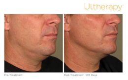 Ultherapy Male Face Lift Results