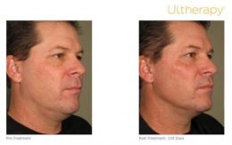 Ultherapy Male Full Face Lift Results