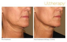 Ultherapy Neck Jawline Results