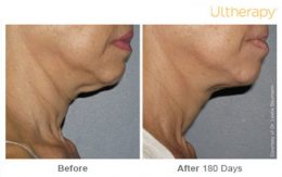 Ultherapy Neck Lift Before and After