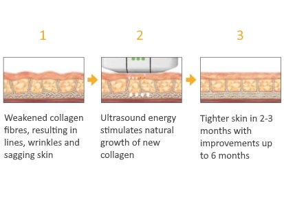 How Ultherapy Works