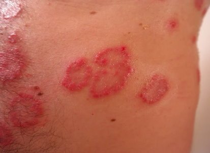 psoriasis-led-treatment