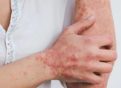 psoriasis arms
