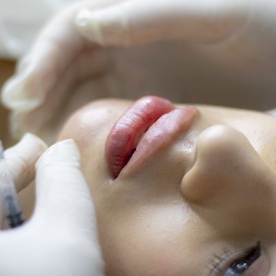 lip filler injections