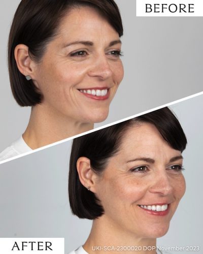 Before and after Sculptra