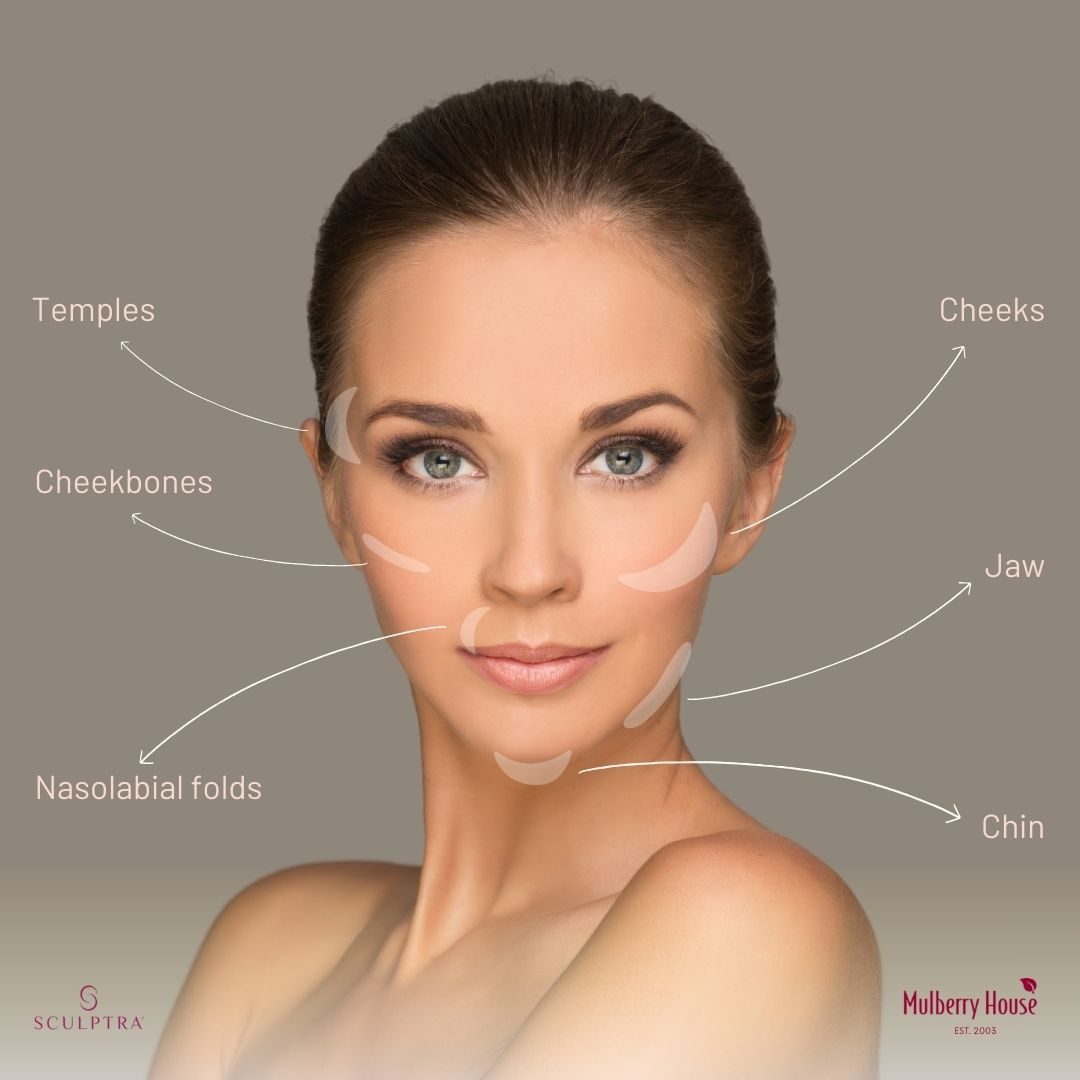 Sculptra treatment areas