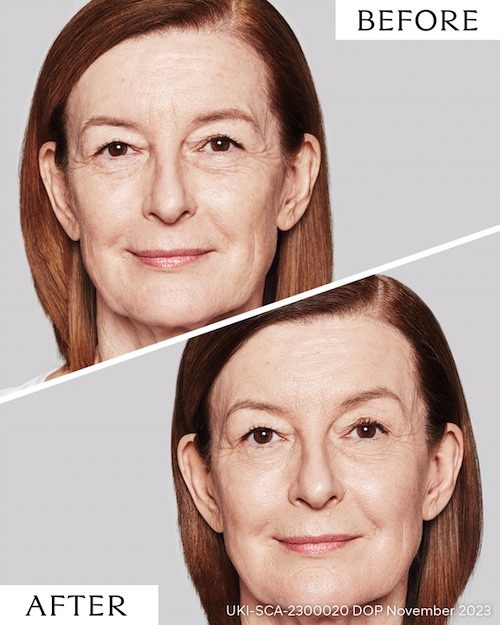 Sculptra treatment collagen results