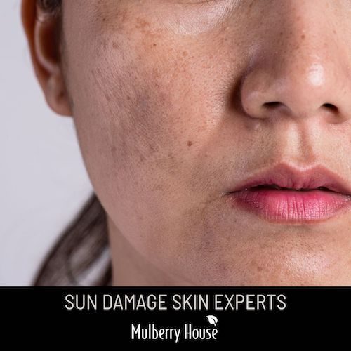 sun damage skin experts